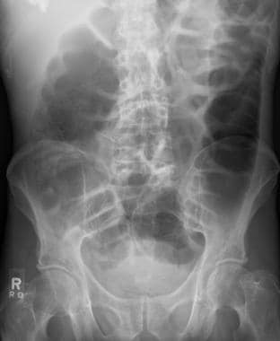 Constipation. This radiograph reveals colon disten