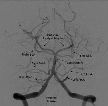 Frontal projection from a right vertebral artery a