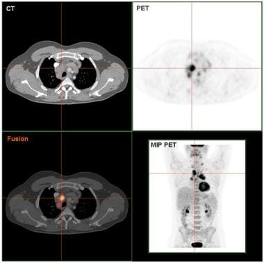 hodgkins lymphoma radiology