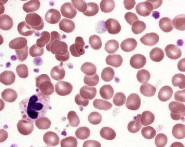 Peripheral blood smear in essential thrombocytosis