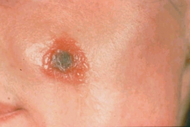 An example of a central ulcer and eschar with surr