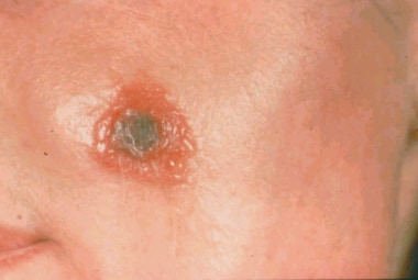 Oropharyngeal Anthrax