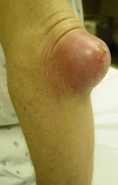 what causes septic bursitis