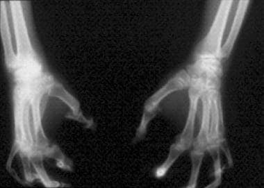 Arthritis mutilans (ie, "pencil-in-cup" deformitie