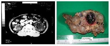 Retroperitoneal hemorrhage due to ruptured renal cyst in PCKD