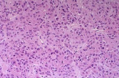 Luteinized thecoma. Vacuolated theca cells with an