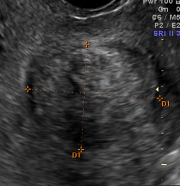 Myoma identified on vaginal ultrasound. 