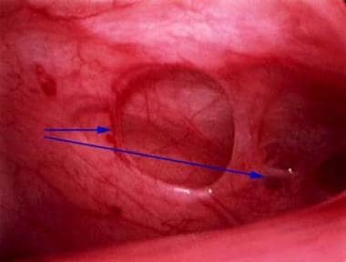 Peritoneal erosions and adhesions in the posterior