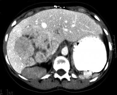 CT scan showing fibrolamellar carcinoma with a lar