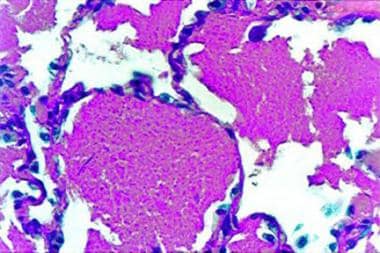 Pulmonary alveolar proteinosis. A periodic acid-Sc