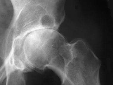 Anteroposterior (AP) radiograph of the hip reveals