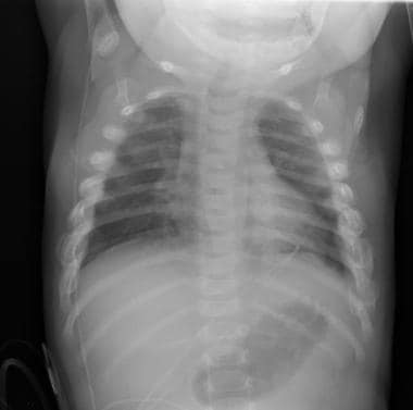 A 3-month-old presented with the chief complaint o