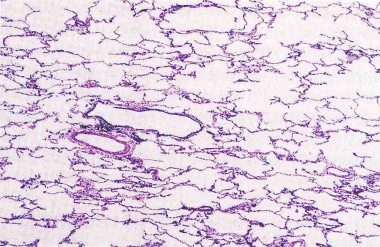 A section from a lung biopsy (hematoxylin and eosi