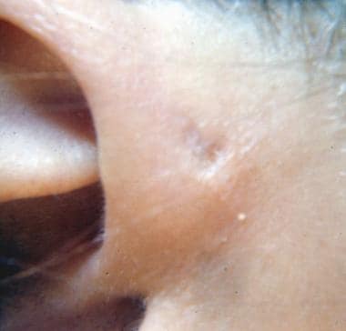 Close-up image of preauricular pit. Image courtesy