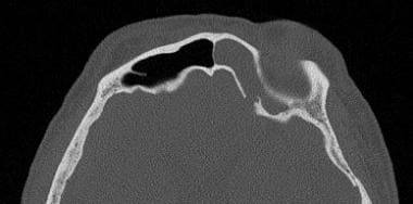 An axial CT of a patient with a spontaneous CSF le