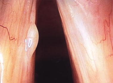 This picture shows the surgical view of a vocal fo