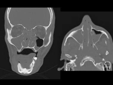 Coronal (left) and axial (right) CT scans of the s