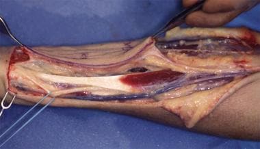 Subfascial dissection is performed in a lateral-to