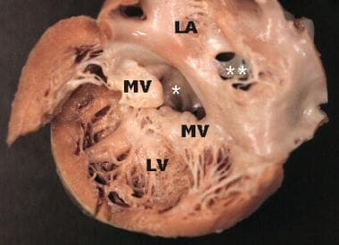 Gross pathology specimen viewed from the opened le
