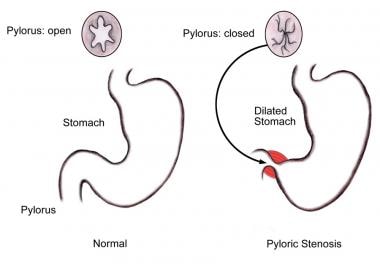Diagram of anatomic changes associated with pylori