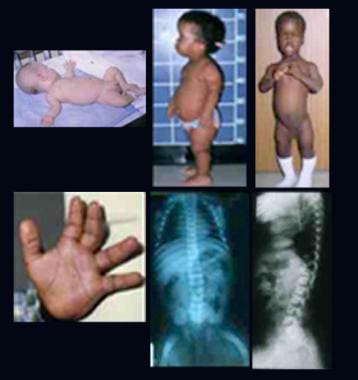 Infant and 2 children with achondroplasia. Note re