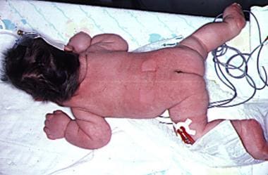 Generalized lymphedema is seen here in an infant. 