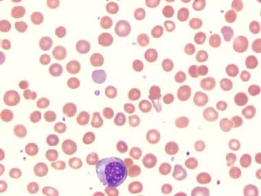 Blood smear of hereditary spherocytosis (HS). Note