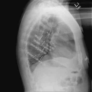 De behandeling van meervoudige ribfracturen omvat t