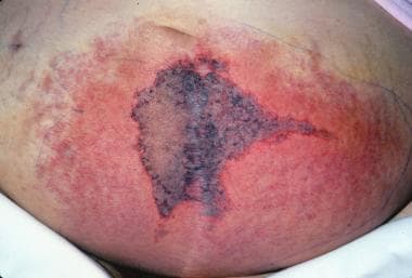 myelodysplastic syndrome skin