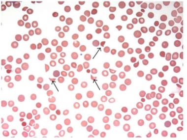 Schistocytes (arrows) on a peripheral smear. Court