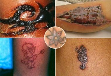 Tattoo hypersensitivity reaction. Exuberant verrucous nodules caused by