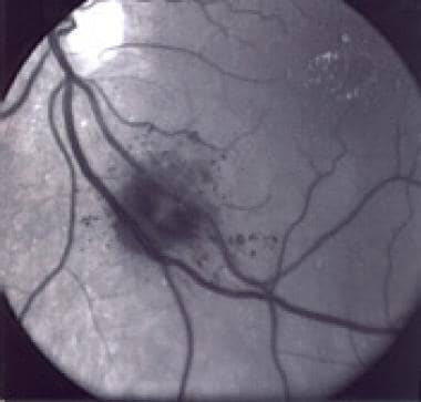 Red-free photograph of left fundus of a 79-year-ol