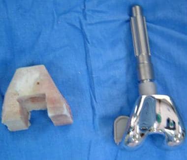 Astemmed femoral prosthesis and allograft used for