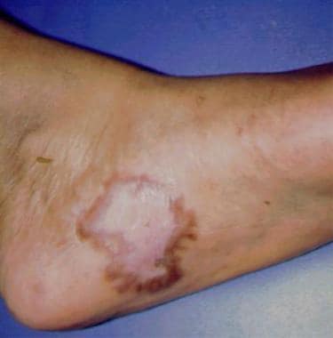 Foot with keloid scar several months postoperative