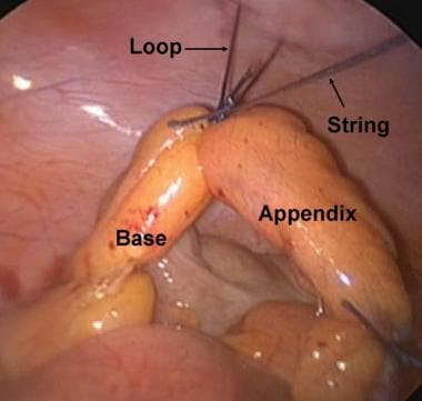 Exposure of appendiceal base. 