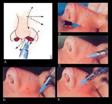 Anesthesia for tip surgery is a regional block tha