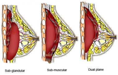 Subglandular, submuscular, and dual-plane breast i