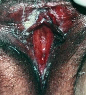 Benign vulvar lesions. Pemphigus vulgaris, mucosal