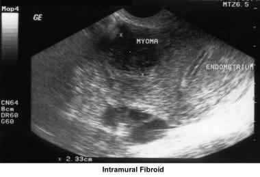 Infertility. Intramural fibroid. Image courtesy of