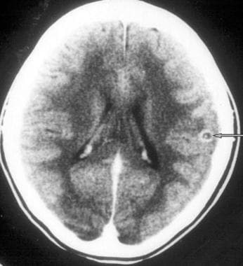 Enhanced CT scan of the brain in a patient with ne