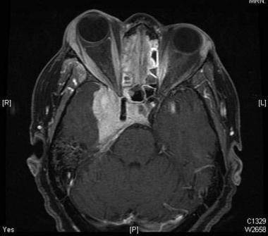 Neurosarcoidosis. CT orbital fissure and MRI orbit