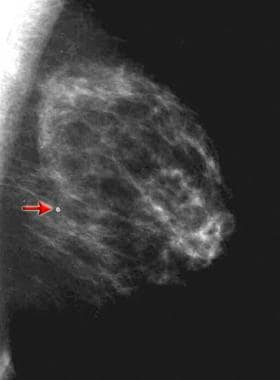 a, b Mammogram of 63-year-old woman. The LCC (left cranialcaudal