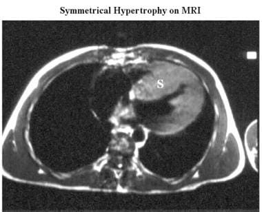 Cardiomyopathy, hypertrophic. Axial electrocardiog