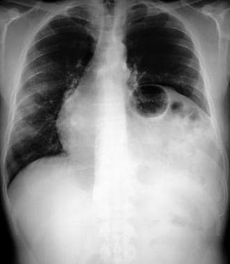A chest radiograph in a patient with a previous le