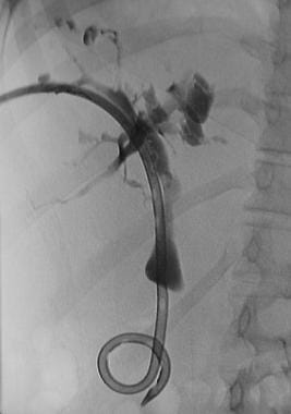 Caroli disease. Image obtained after percutaneous 