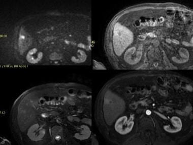 MRI of liver in patient with liver lesion initiall