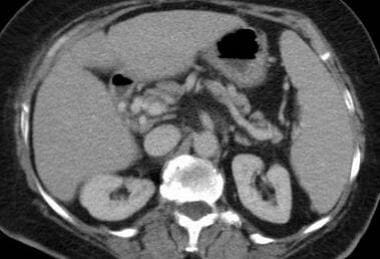 Mesenteric ischemia. CT scan in a 76-year-old woma