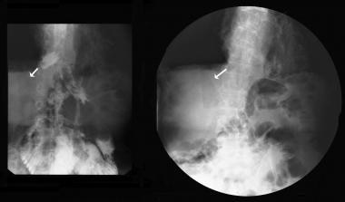 Pneumoperitoneum. A 49-year-old man was admitted t
