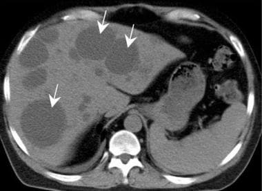 Polycystic liver disease (arrows) may complicate s