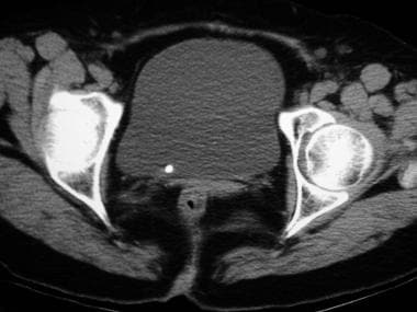 Axial nonenhanced CT image of the urinary bladder 